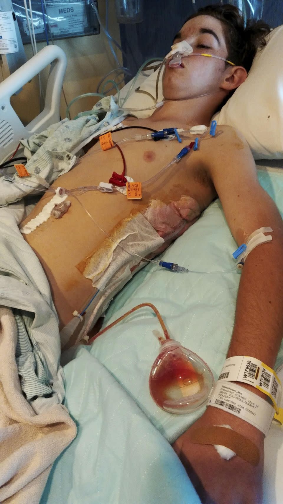 The Missouri teen was forced to undergo emergency surgery, with doctors saying he was hours away from death. Photo: SWNS/Mega