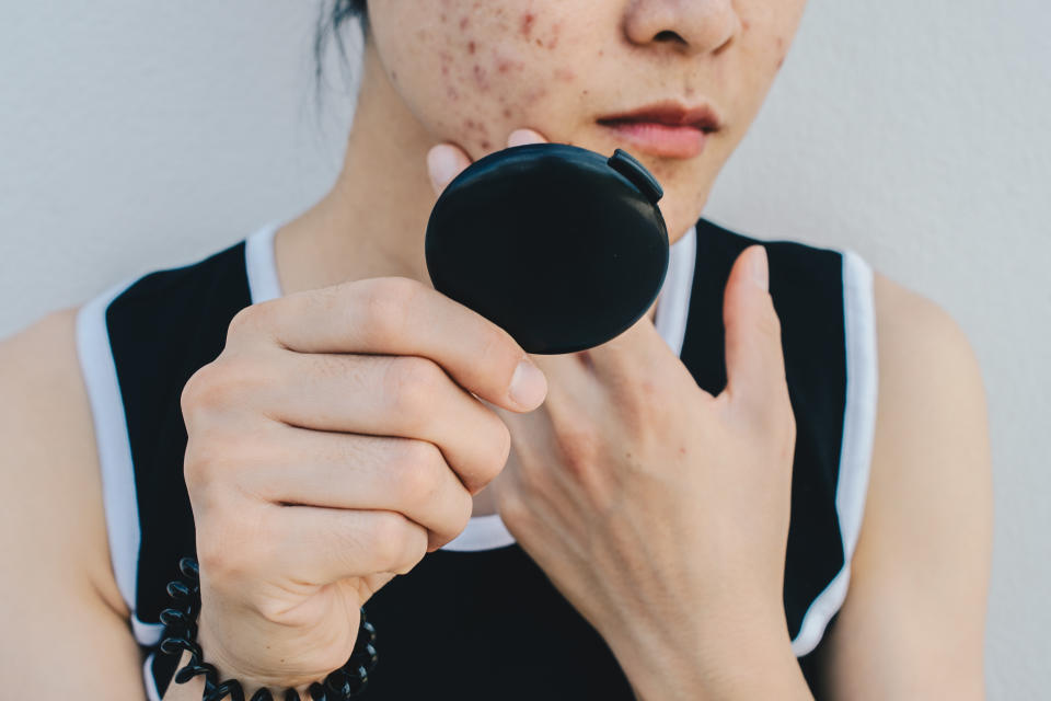 Conceptual shot of Acne & Problem Skin on female face.