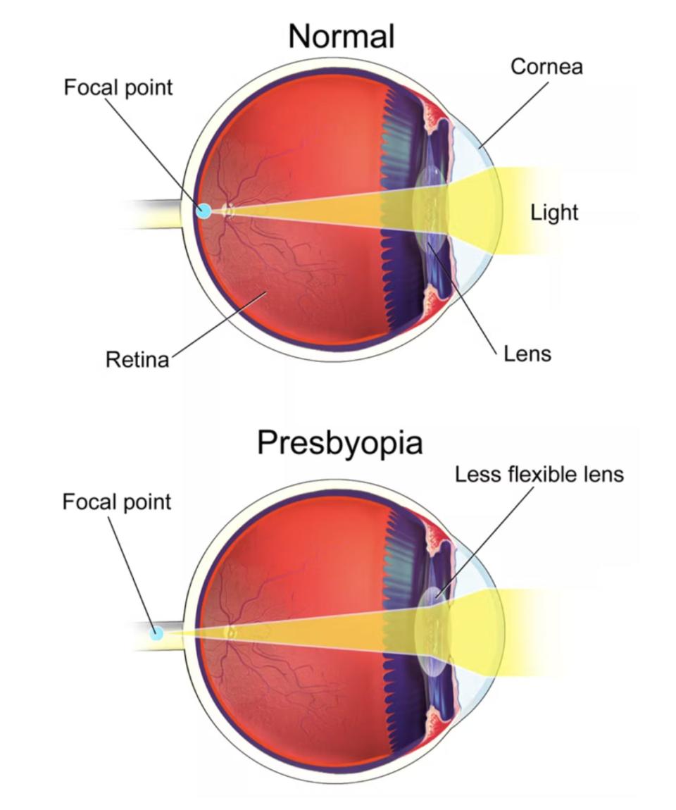 <div class="inline-image__caption"><p>Presbyopia stiffens the lens in the eye, and when a person can’t bend their lens as easily, they are unable to focus incoming light on the correct part of the retina and images appear blurry.</p></div> <div class="inline-image__credit">BruceBlaus via WikimediaCommons</div>