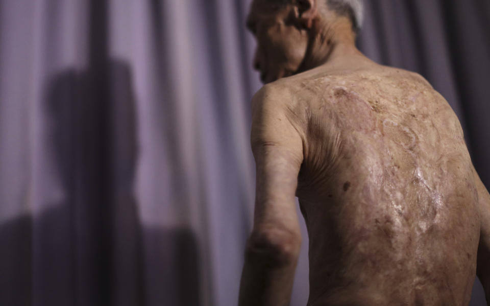 FILE - In this June 30, 2015, file photo, Sumiteru Taniguchi, a survivor of the 1945 atomic bombing of Nagasaki, shows his back with scars of burns from the atomic bomb explosion, during an interview at his office in Nagasaki, southern Japan. With dwindling survivors, Nagasaki marked 75th anniversary of US atomic bombing that killed more than 70,000 people on Sunday, Aug. 9, 2020. (AP Photo/Eugene Hoshiko, File)