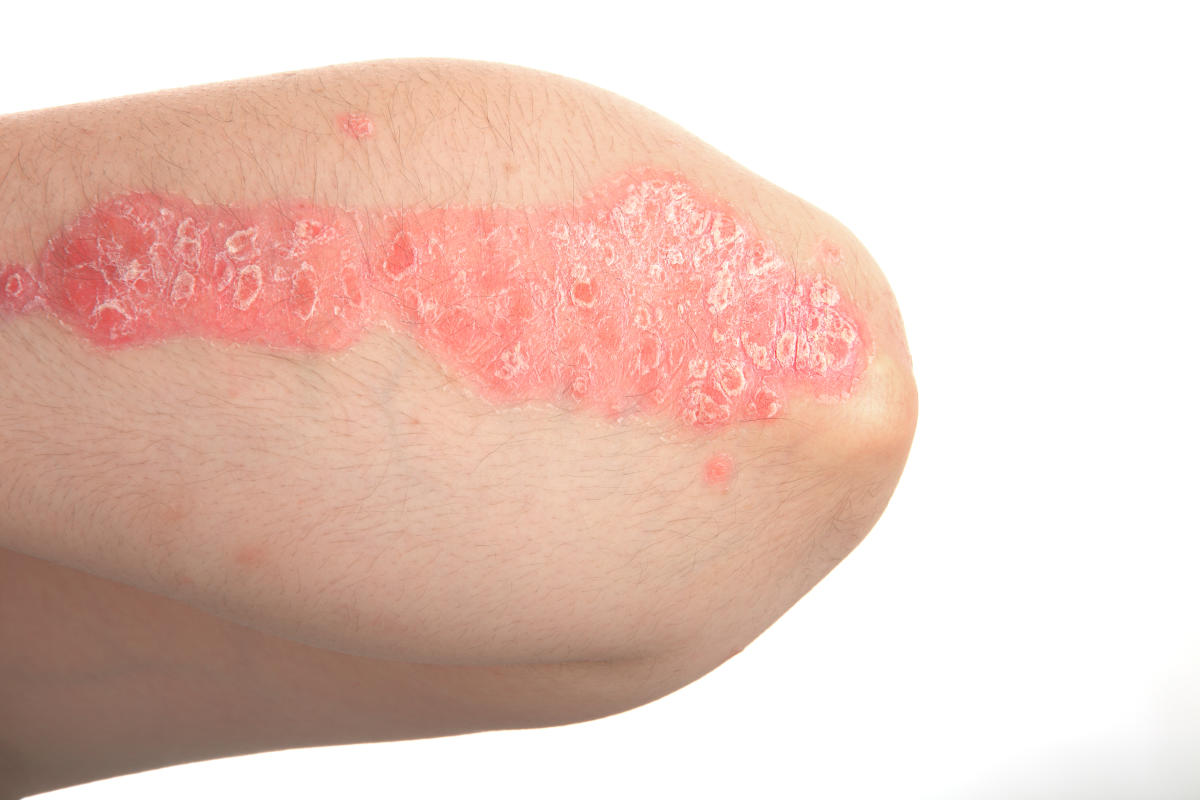 Six Important Facts About Common Skin Diseases Archyde