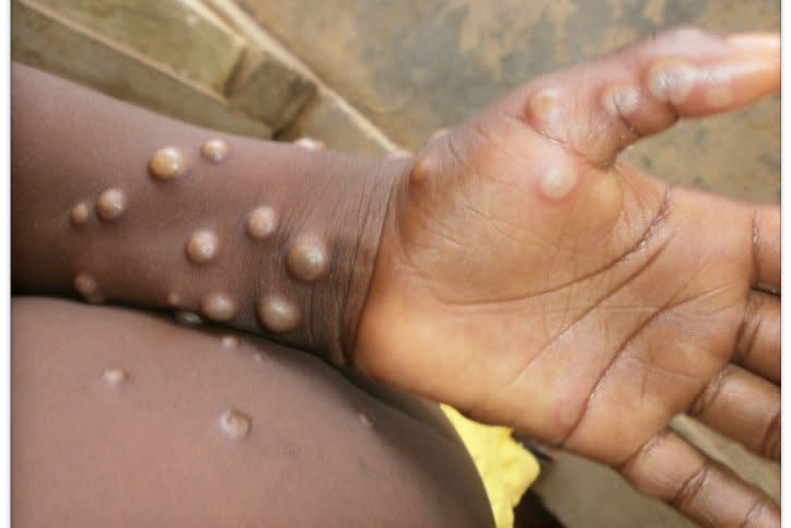 The number of reported mpox cases in the United States is nearly double what it was last year at this time, the Centers for Disease Control and Prevention said Thursday. Photo courtesy of the World Health Organization