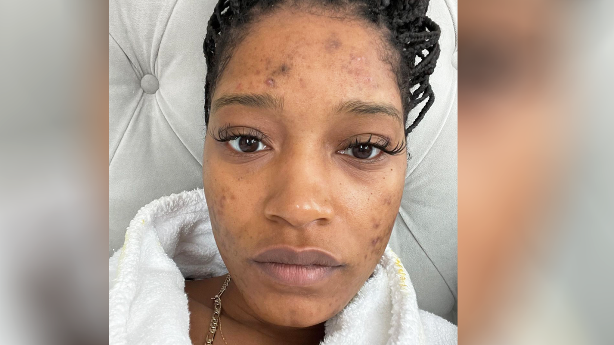 keke palmer pcos acne