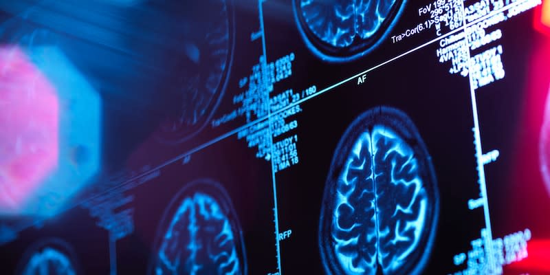 Das Bild zeigt einen Gehirnscan. Der Normaldruckhydrocephalus (NPH) ist eine Erkrankung, bei der sich zu viel Gehirnflüssigkeit (Liquor) im Gehirn ansammelt, was zu einer Erweiterung der Ventrikel und verschiedenen Symptomen führt.<span class="copyright">Getty Images/Image Source</span>