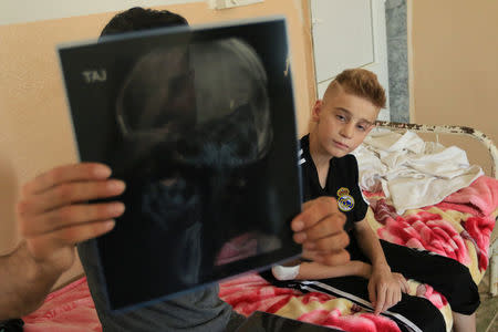Barzan Tammo, the uncle of twelve year-old Yazidi boy Imad Tammo who was rescued from Islamic State militants by the Iraqi army, looks at Imad's X-rays in Sina neighbourhood outside of Duhok, Iraq July 25, 2017. REUTERS/Ari Jalal