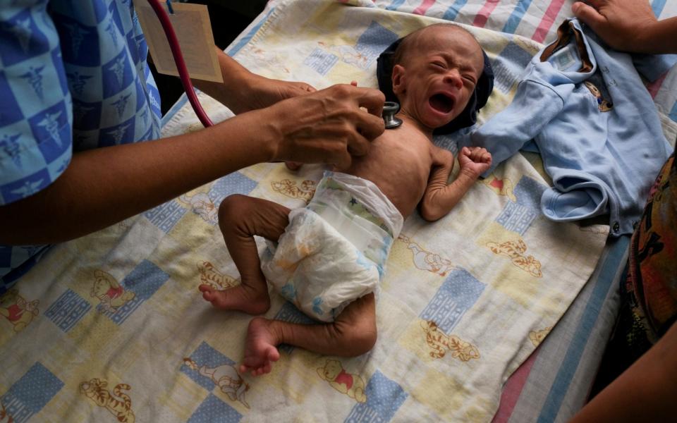 Two month old Kenai Rivero is checked by doctors for malnutrition - CARLOS GARCIA RAWLINS /Reuters