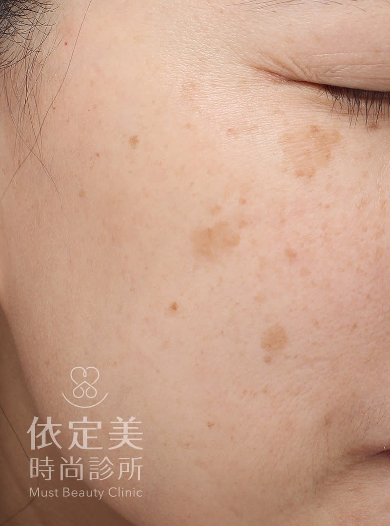 依定美治療前，會透過皮膚影像檢測儀進行膚況分析，圖片由台北除斑雷射推薦依定美時尚診所提供。