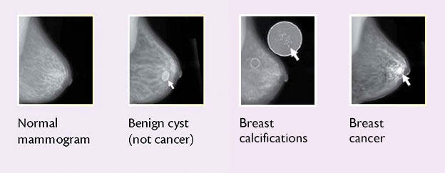 What Does Breast Cancer Red Bumps Look Like