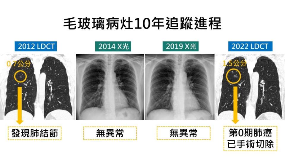 病患肺結節10年病灶演變肺癌進程圖示。(門諾醫院提供)
