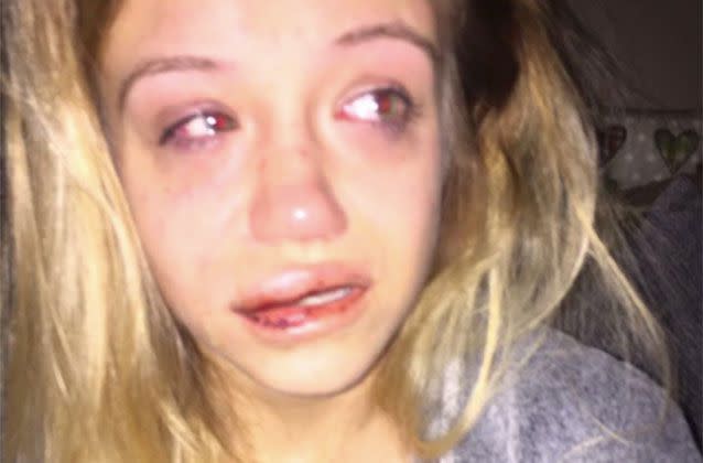 With a bruised face, Sophie Wakefield, 21, has told of how she can no longer sleep and is a nervous wreck since the violent home invasion. Picture: Facebook