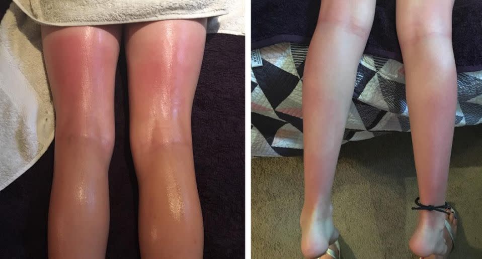 Image of sunburnt legs Ombra sunscreen