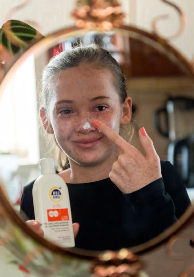 She must wear a special helmet and suncream to protect her from the sun. Photo: Caters