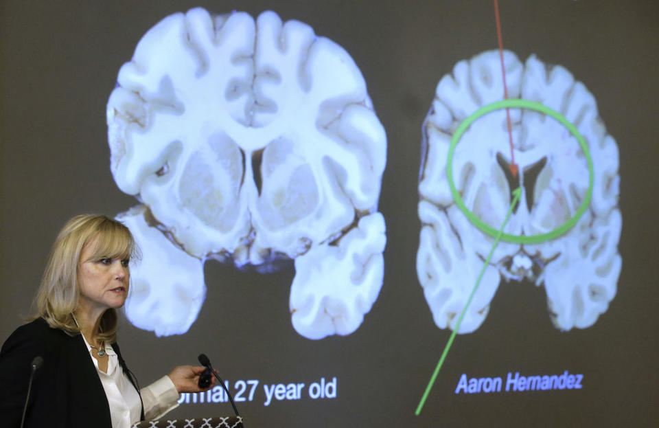 Dr. Ann McKee, director of Boston University's Center for Research on the Degenerative Brain Disease Chronic Traumatic Encephalopathy (CTE), speaks to an audience on the university's campus about the study of NFL football player Aaron Hernandez's brain on Thursday, Nov. 9, 2017. McKee says Hernandez suffered severe damage to parts of the brain that play an important role in memory, impulse control and behavior. The cross-section of the brain, projected to the back left, is labeled as a normal 27-year-old (AP)