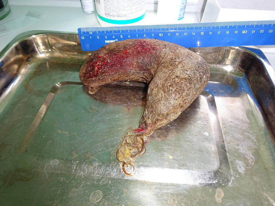 Pictured is the giant hairball that was pulled from the girl's stomach by Russian doctors.
