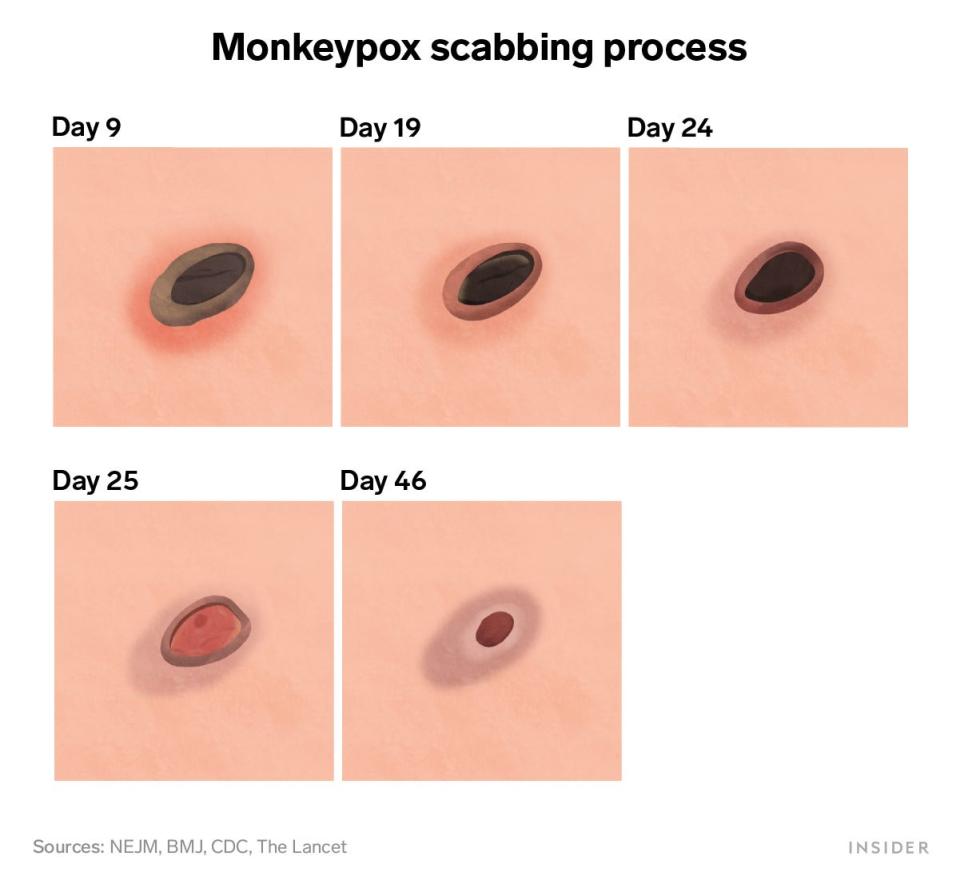 Monkeypox scabbing process