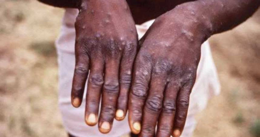猴痘病毒在退燒後，會在患者身上留下許多皮疹。（圖／翻攝自Facebook）