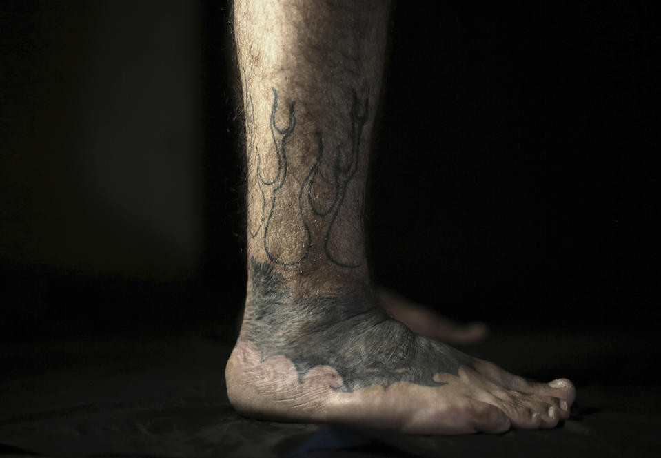 In this Wednesday, Oct. 24, 2018, photo, Iraqi soldier Saad Khudeir displays his tattoo on his leg covering scars of the burns he suffered in a car bomb attack, in Baghdad, Iraq. The tattoos run all over his body. They are not only to hide his war scars, but also to document his emotional ones.(AP Photo/Hadi Mizban)