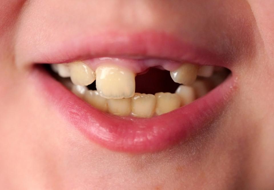 The Tooth Fairy knows the drill — $20 for a first tooth has become popular across the country, with some parents going well beyond that. Christopher Sadowski