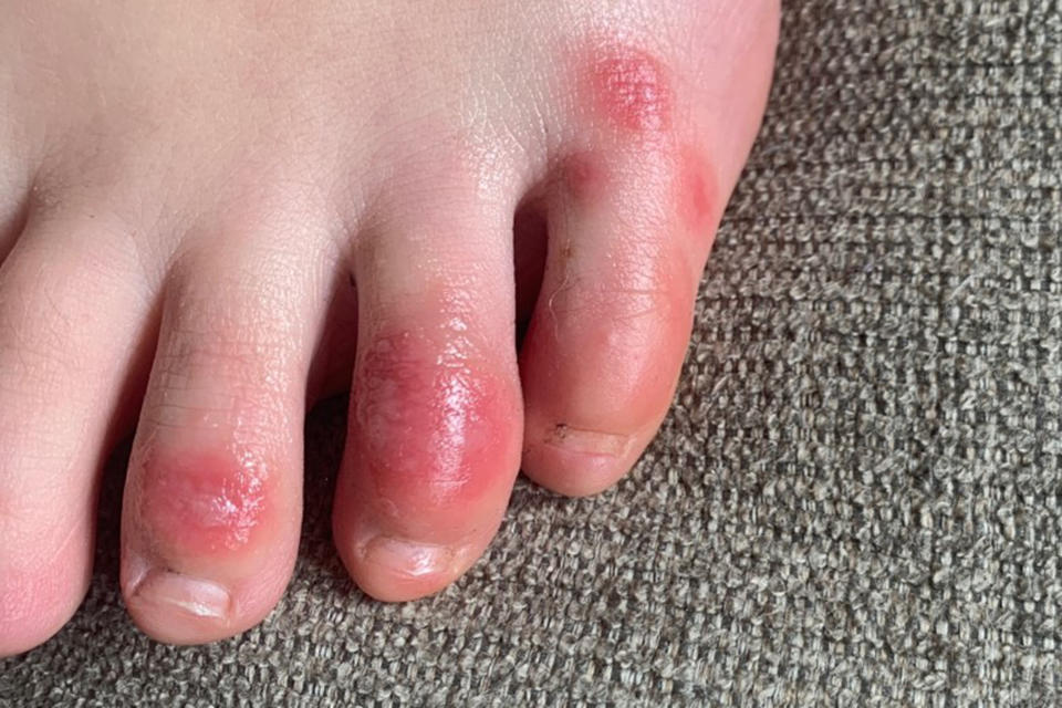 This April 3, 2020 photo provided by Northwestern University shows discoloration on a teenage patient's toes at the onset of the condition informally called "COVID toes." The red, sore and sometimes itchy swellings on toes look like chilblains, something doctors normally see on the feet and hands of people who’ve spent a long time outdoors in the cold. (Courtesy of Dr. Amy Paller/Northwestern University via AP)