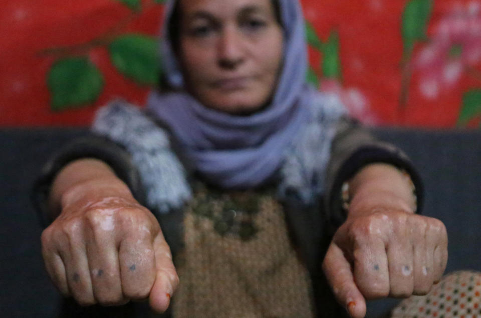 In this Thursday, Feb. 28, 2019 photo, Baseh Hammo, a Yazidi woman who escaped enslavement by Islamic State group militants, shows the injuries to her hands that was carried out by an Albanian who forced her to put her hands on hot asphalt, then stomped on them with his boots, at a relatives's tent in a camp for displaced people outside Dahuk, Iraq. Yazidi women enslaved by the Islamic State group who escaped captivity say there could be hundreds of other women still missing, women who may never return home. (AP Photo/Khalid Mohammed)