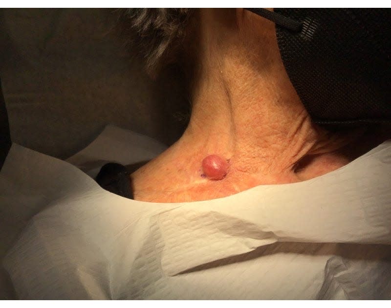 Merkel cell carcinoma looks like a red or blue glossy bump on the skin.