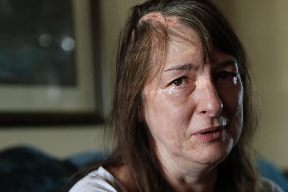 In this Feb. 10, 2020 photo, Genette Hofmann sits in her home in Burlington, Wash., and cries as she about her ongoing recovery a few weeks after undergoing brain surgery in Seattle. Since the operation, in addition to her scar healing, Hofmann says she has dealt with some memory and pain issues, as well as having her emotions swing widely as she continues to recover. (AP Photo/Ted S. Warren)