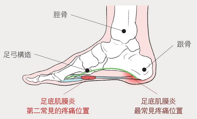 足底筋膜炎