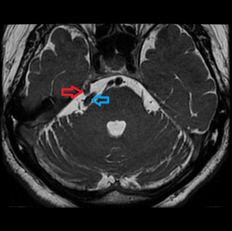 紅色箭頭處為三叉神經，藍色箭頭處為脊椎動脈，術前核磁共振顯示，林先生的脊椎動脈已嚴重壓迫三叉神經。