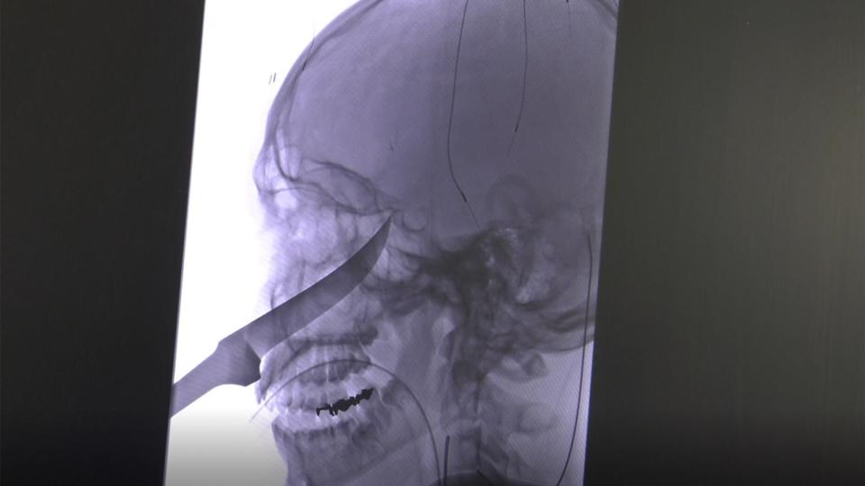 An X-ray shows the extent of the knife's penetration into the boy's head. (Photo: University of Kansas Health)