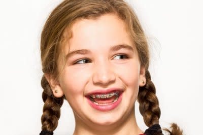 Eight-year-old Bailey Berman received braces to correct a crooked front tooth. Photo courtesy of the Wall Street Journal.