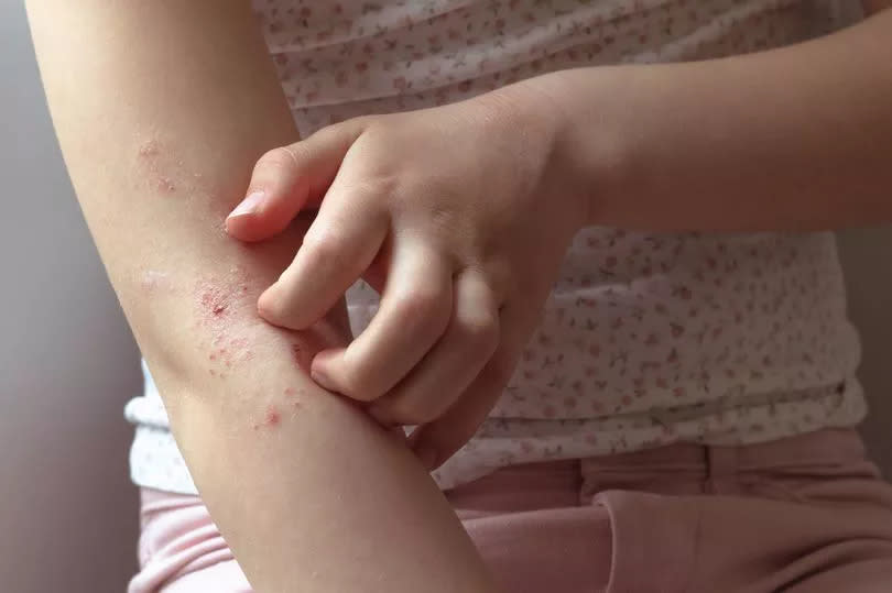 Eczema on right arm, left hand scratching the skin. Girl is wearing a white sleeveless top with flowers and pink pants.