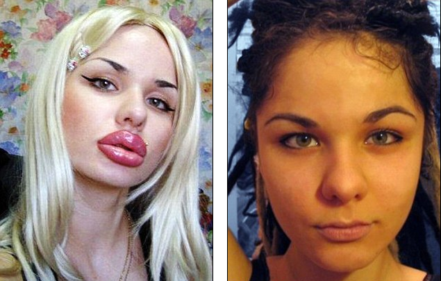 Her current Trout Pout, and before injections at age 15