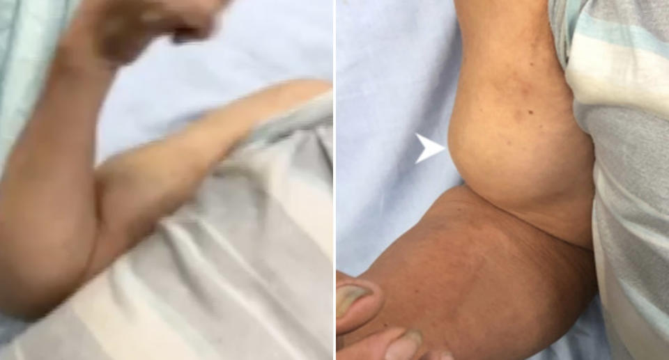 A 72-year-old man diagnosed with Popeye sign on his arm.