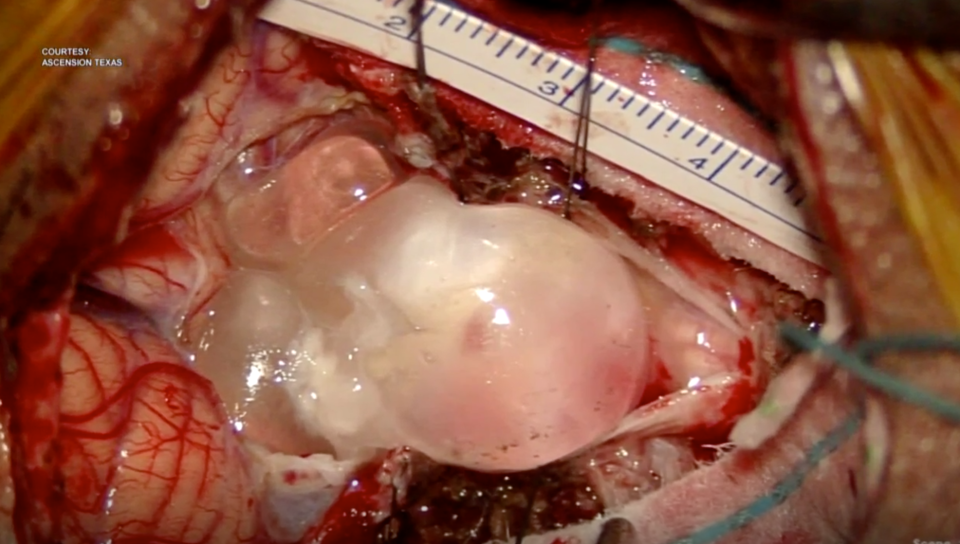 The tapeworm inside the man's brain during surgery. Source: CBS Austin