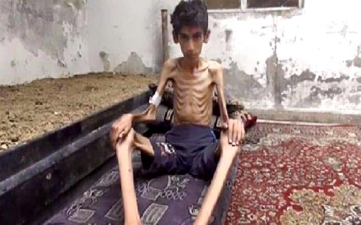 A starving boy in Madaya - Credit: Local Revolutionary Council in Madaya via AP