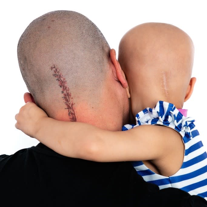 Aaron Lambert, 36, got a tattoo of his daughter Esme's brain surgery scar so she does not feel like the 'odd one out'. (Wendy Lambert/ PA)