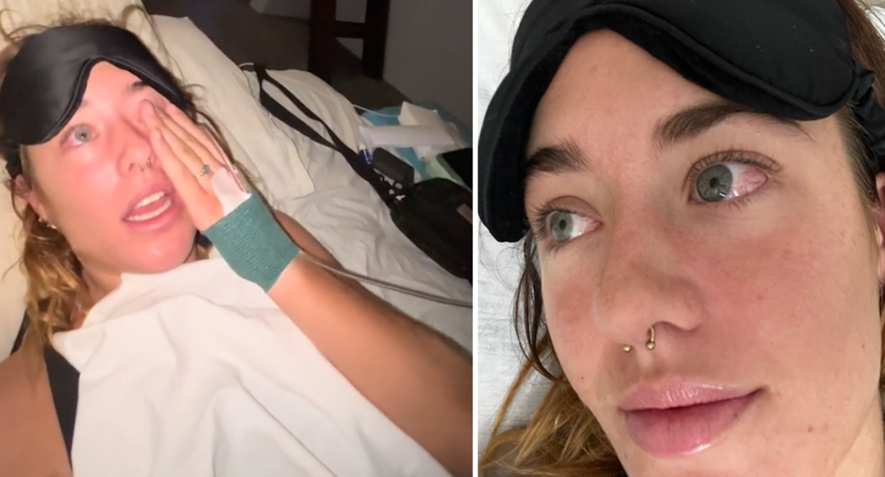Marley lies in a Bali hospital bed rubbing her eye looking physically unwell after contracting dengue fever (left). She shows her bloodshot eye to the camera (right). 