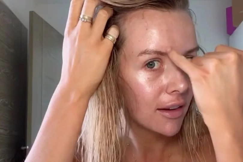 Faye Winter points to patch of sun damage on her skin