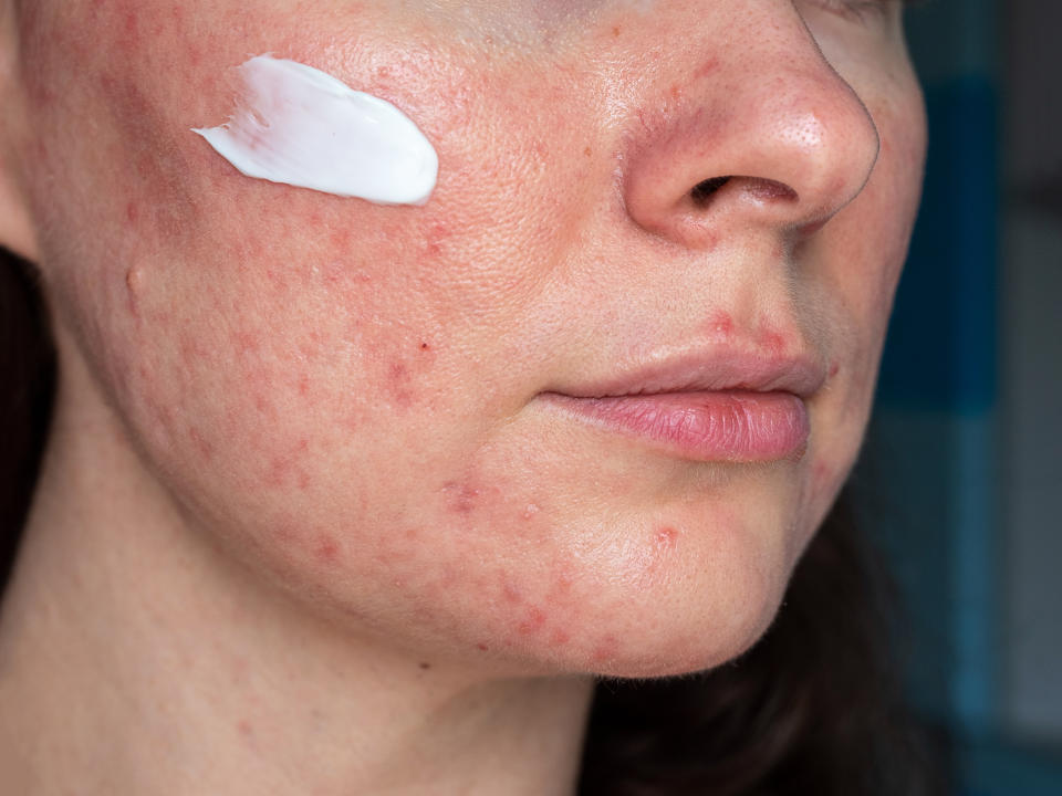 A woman with rosacea is close to the medicinal oil on her face