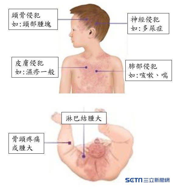 蘭格罕細胞組織球增生症表現是十分多樣化，圖表為比較常見的。（圖／巫康熙醫師授權提供）