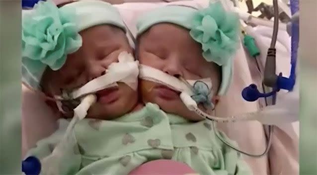 Conjoined twins Emily and Sophie. Source: WFMYNEWS2.com
