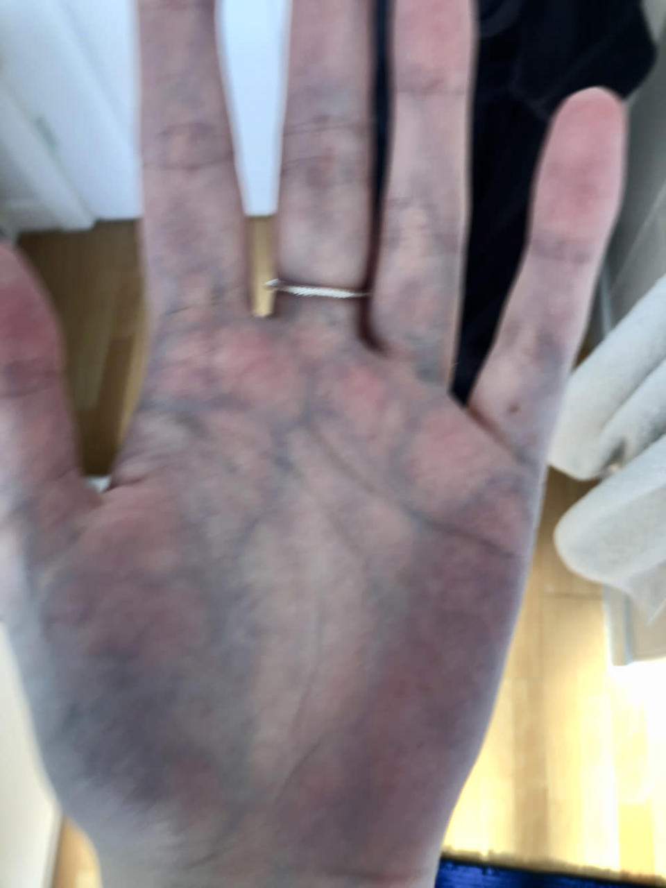 Katherine Frances, 29, said she often has blue hands because of her poor circulation (Collect/PA Real Life)