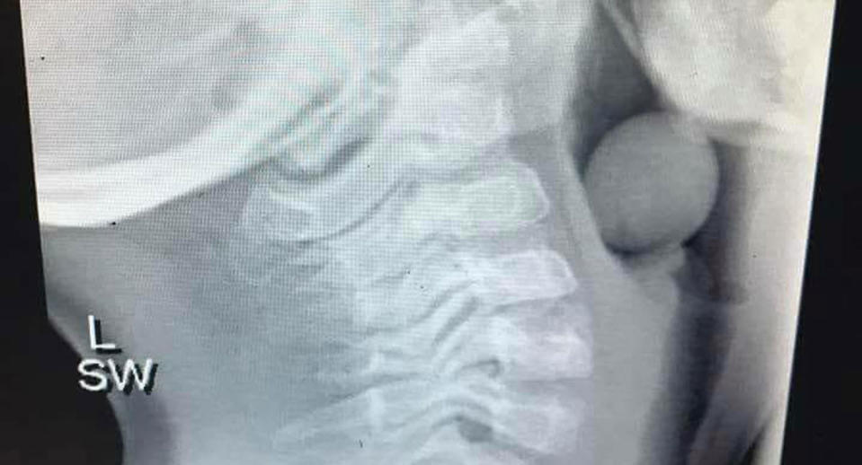 An X-ray shows a grape lodged in a child's throat.