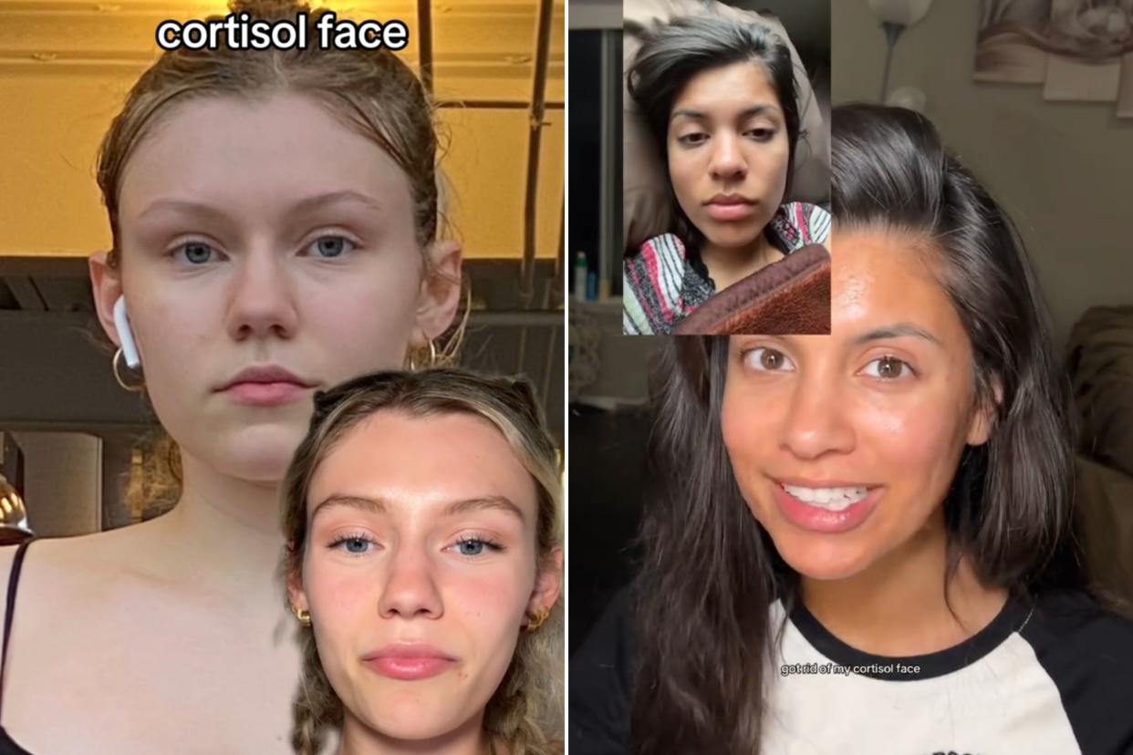 Two young women with before and after facial puffiness