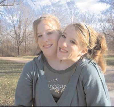 Amazing story of conjoined twins Abigail and Brittany Hensel