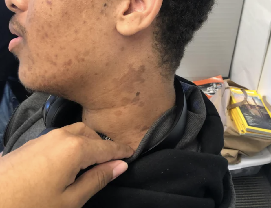 a turtle-shaped birthmark on someone's neck