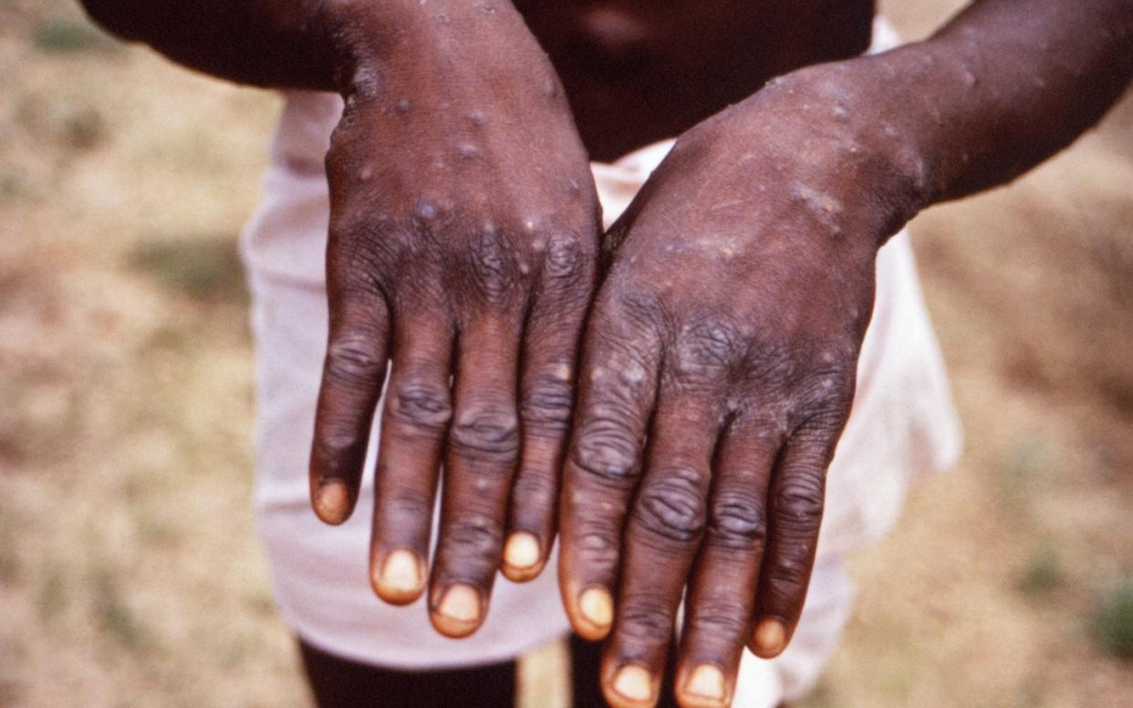 A monkeypox patient in Africa, where cases of the the viral infection are on the rise - www.alamy.com