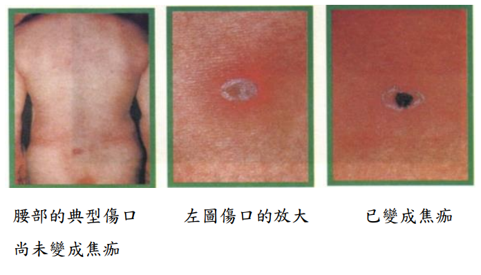 約5至8成患者，被恙蟎叮咬處會形成焦痂。（圖／疾管署）