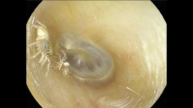 The spider and its molted exoskeleton found inside the woman’s ear.