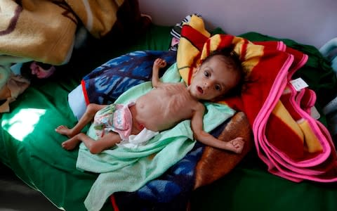 A malnourished Yemeni child receives treatment at a hospital in the capital Sanaa - Credit: MOHAMMED HUWAIS/AFP/Getty Images